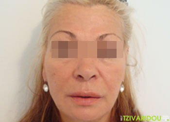 Φωτογραφία facelif προσώπου-λαιμού μετά