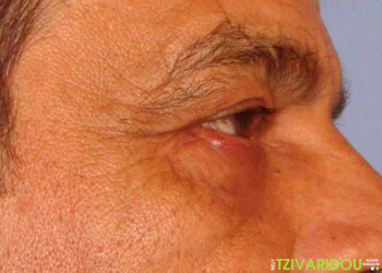 Φωτογραφία Βλεφαροπλαστική επέμβασης μετά 1