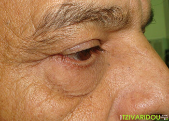 Φωτογραφία Βλεφαροπλαστικής επέμβασης 1 πριν